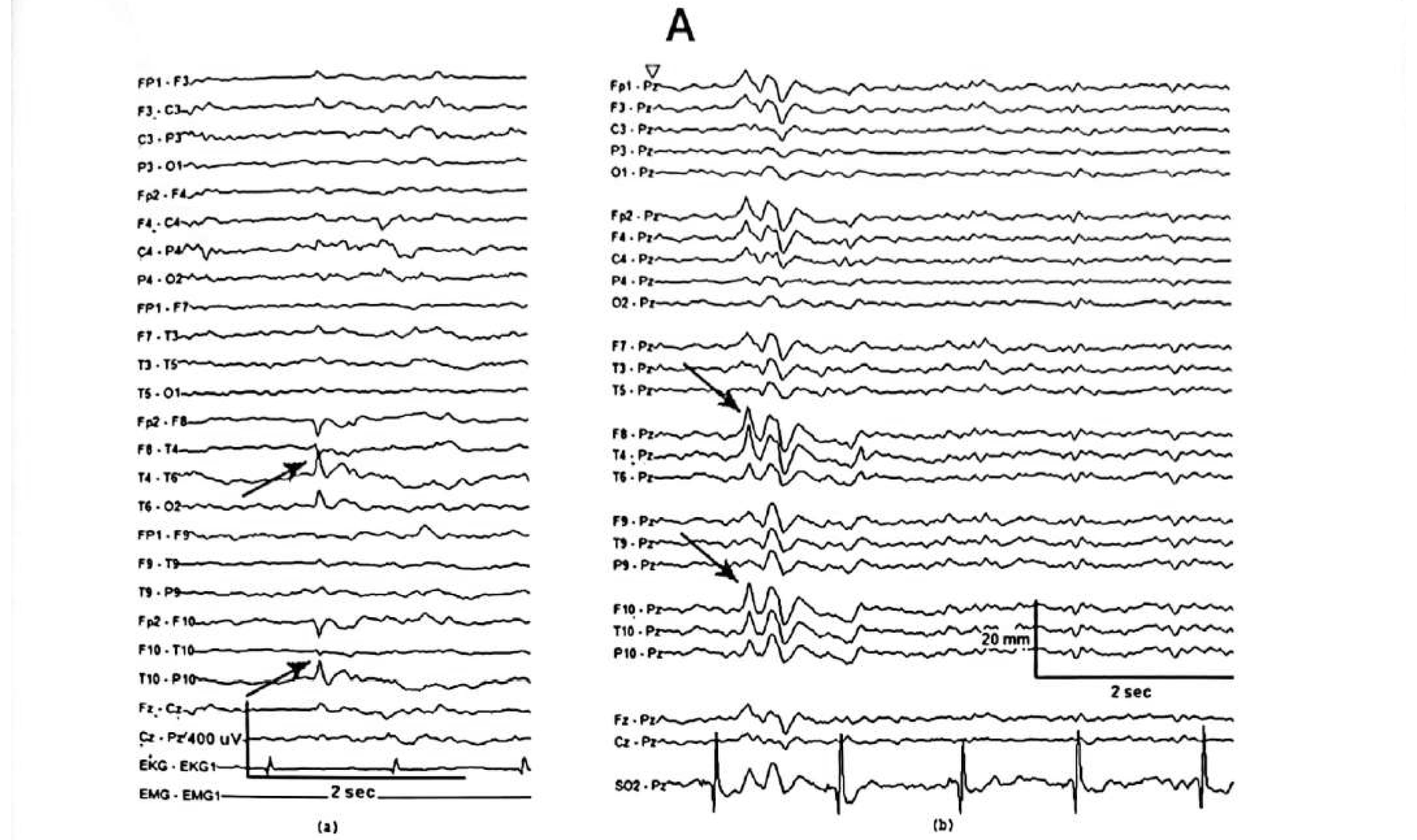 Figure 11.10 A · Longitudinal bipolar montage showing IEDs phase reversing at T4/T10; the referential montage confirms maximum amplitude at T4/T10.