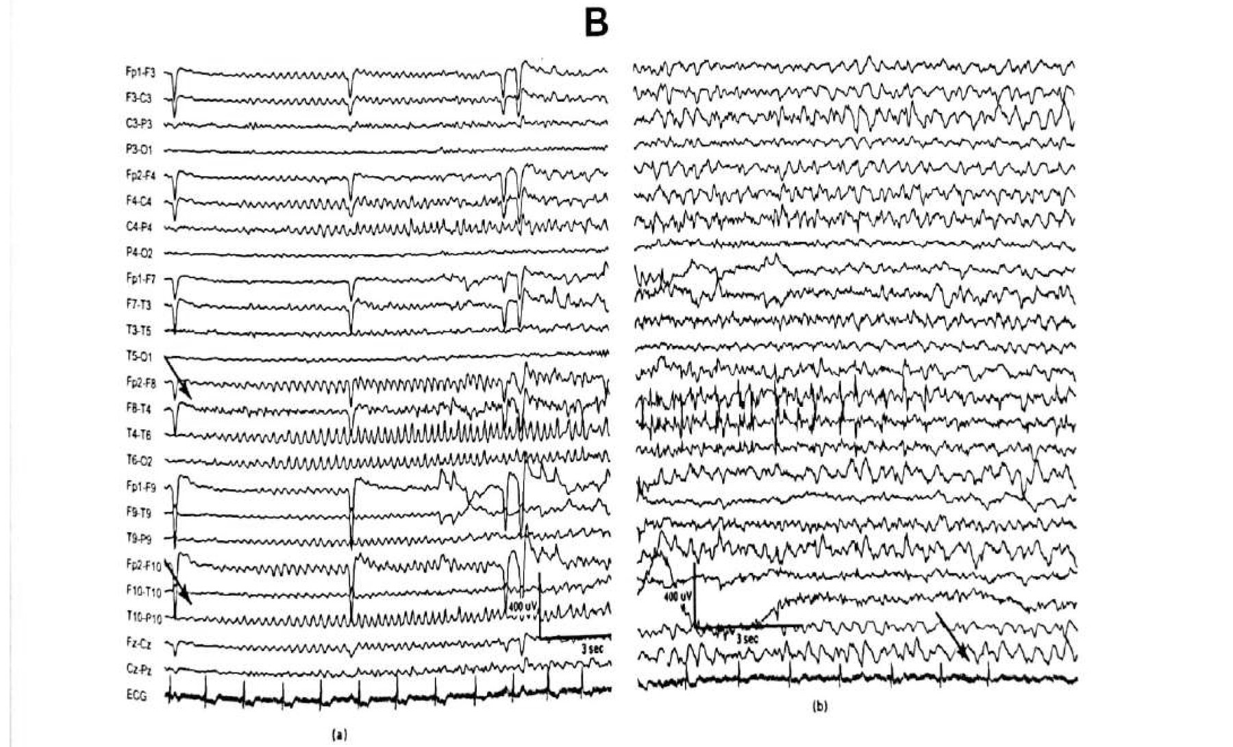 Figure 11.10 B · Scalp-recorded ictal activity as 5 Hz rhythmic theta, better expressed over the right temporal region but <strong>more widespread</strong> and seen over the right centro-parietal region as well.
