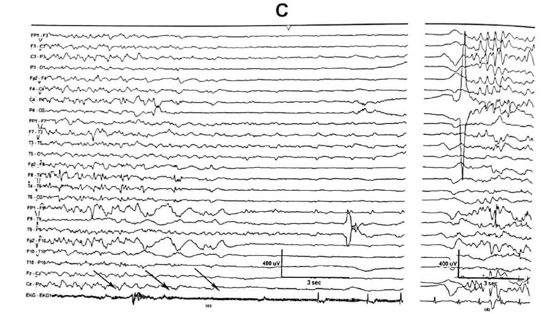 Figure 11.10 C · During cardiac asystole there is generalised attenuation of EEG activity, which is restored on reappearance of the cardiac rhythm. Note the evolving bradycardia and sinus arrest during the seizure.