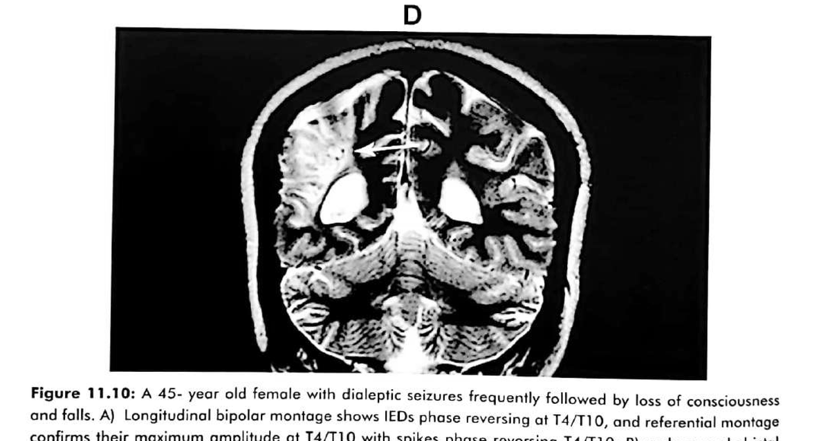 Figure 11.10 D · MRI brain, coronal T2, showing right parietal gliosis and ulegyria. The overall electroclinical and MRI features suggest a temporal plus syndrome.