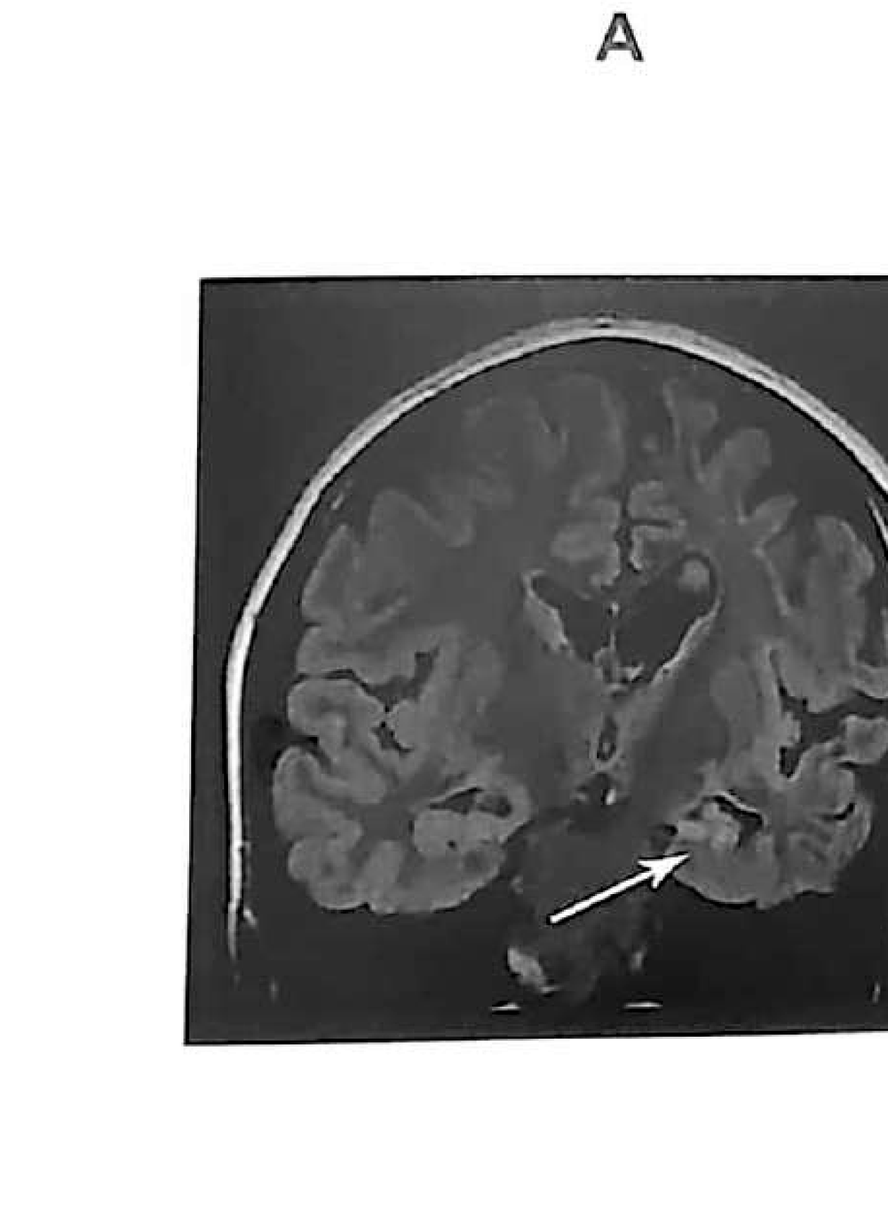 Figure 11.11 A · MRI showing atrophy of the left hemisphere with marked left hippocampal atrophy.