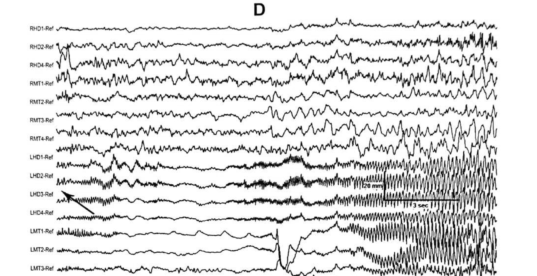 Figure 11.11 D · Invasive recording confirming that all recorded seizures originated from the <strong>left</strong> hippocampus. LHD — left hippocampal depth; RHD — right hippocampal depth; LMT — left mesial temporal strip; RMT — right mesial temporal strip.