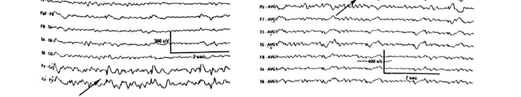 Figure 11.12 A · Frequent runs of spikes phase reversing across C4/Cz.