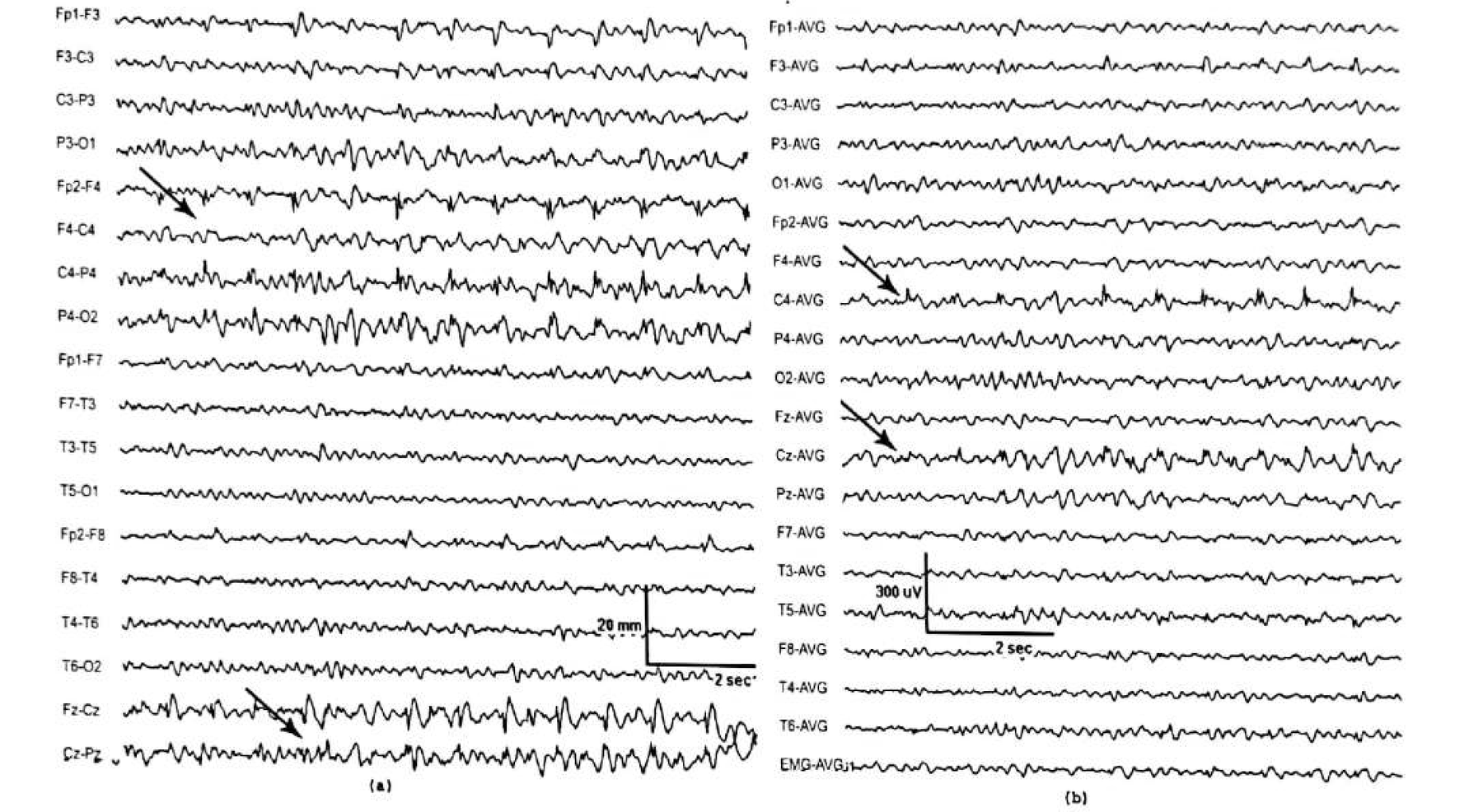 Figure 11.12 B · Pre-ictal potentiation of the spikes in the same location.