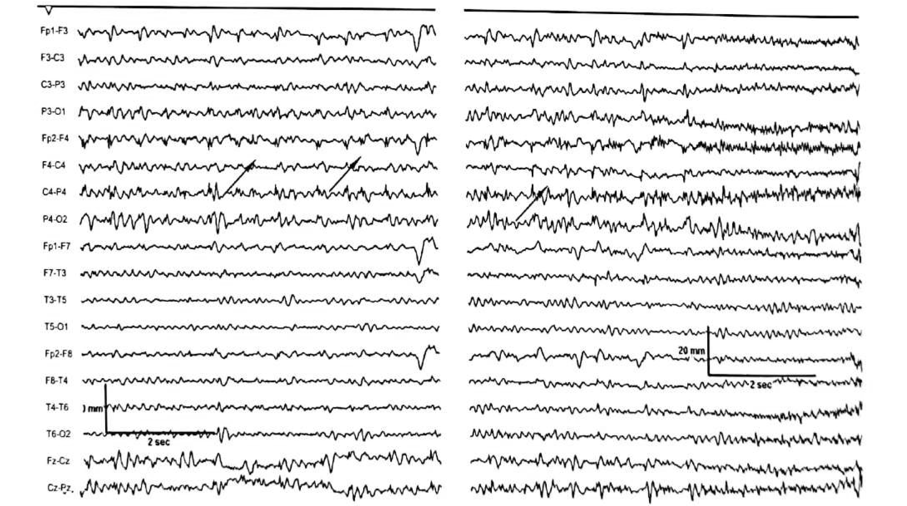 Figure 11.12 C · The pre-ictal potentiation progresses to an electrographic seizure pattern in the same location.