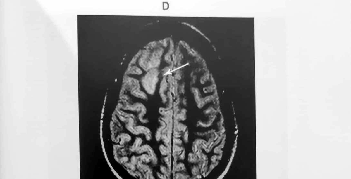 Figure 11.12 D · MRI FLAIR sequence revealing a focal cortical dysplasia, with cortical thickening and blurring of the grey–white junction of the right superior frontal gyrus.