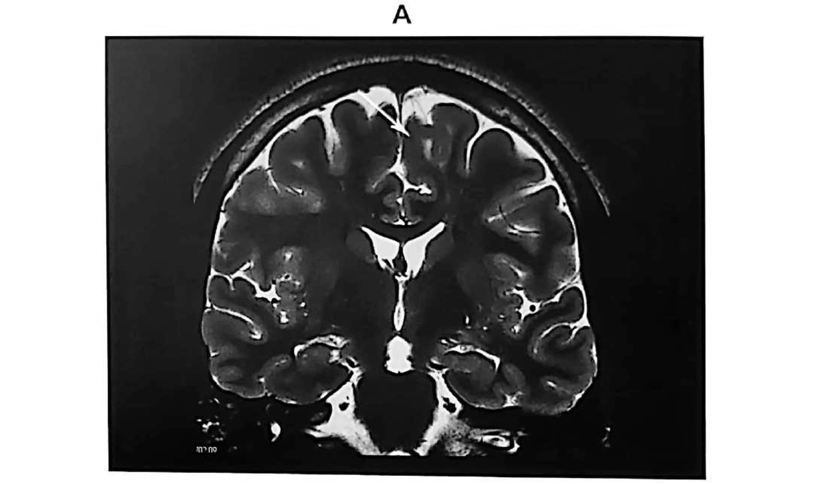 Figure 11.13 A · MRI showing focal cortical dysplasia with a transmantle sign, located in the <strong>left</strong> superior frontal gyrus close to the midline.