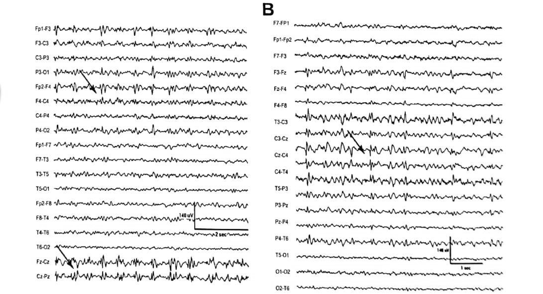 Figure 11.13 B · Note the IEDs phase reversing at Cz and F4 — midline and <strong>right</strong> — despite a left-sided lesion.