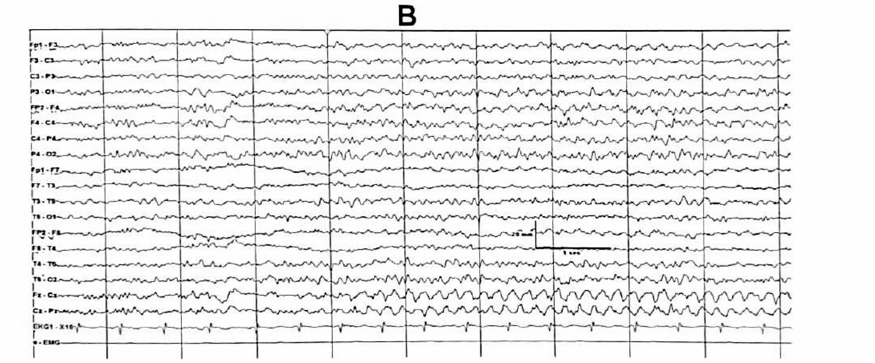 Figure 11.14 B · During drowsiness, 4.5 Hz rhythmic sharp-contoured theta appeared at the midline central region with phase reversal at Cz, with evolution and resolution.