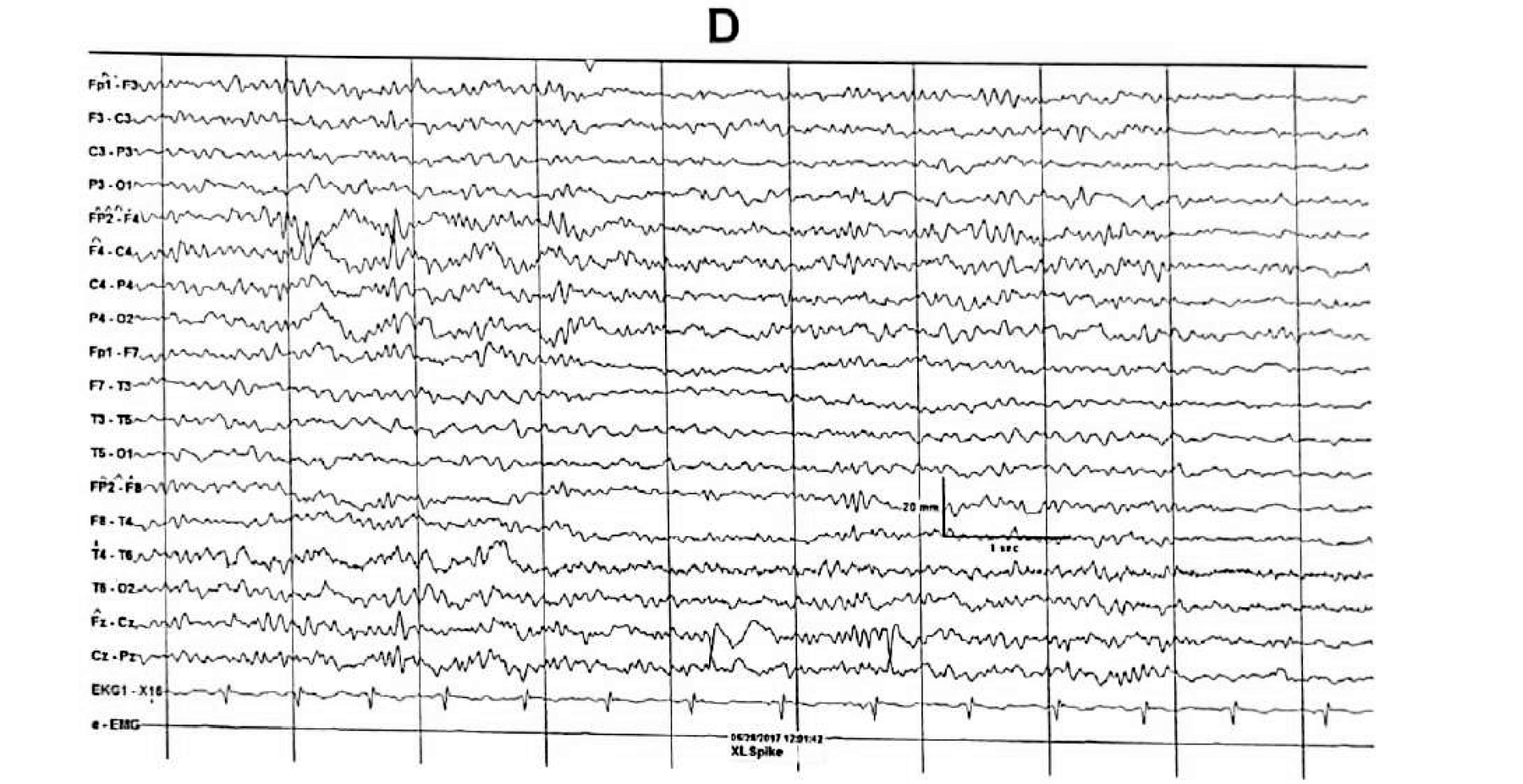 Figure 11.14 D · During sleep, spikes appeared over the central region with phase reversal at Cz.