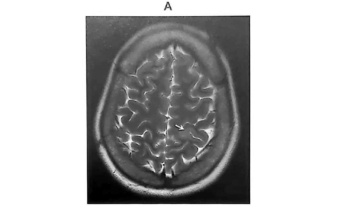 Figure 11.15 A · MRI axial T2-weighted sequence showing focal cortical dysplasia in the <strong>left parietal lobe</strong>.
