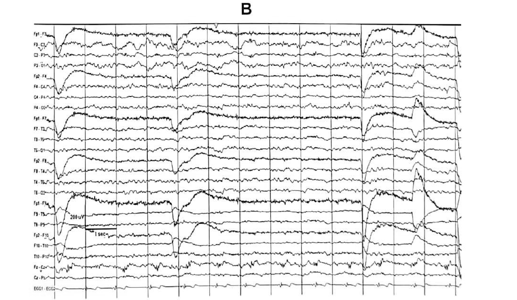 Figure 11.15 B · IEDs in the form of periodic multiple spike complexes over the left central and parietal regions. Note the regular heart rate of 66/min.