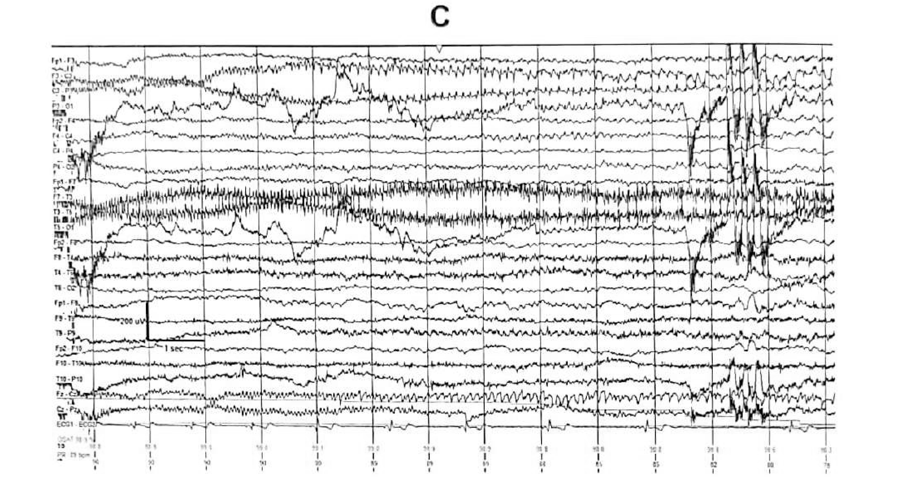 Figure 11.15 C · During a seizure, fast rhythmic activity evolved over the left centro-parietal region. Note the progressive bradycardia.