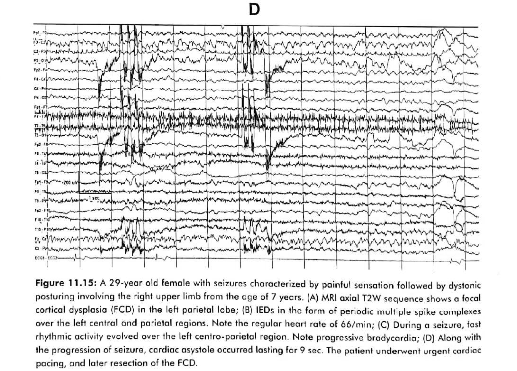 Figure 11.15 D · With progression of the seizure, cardiac asystole occurred, lasting 9 seconds.