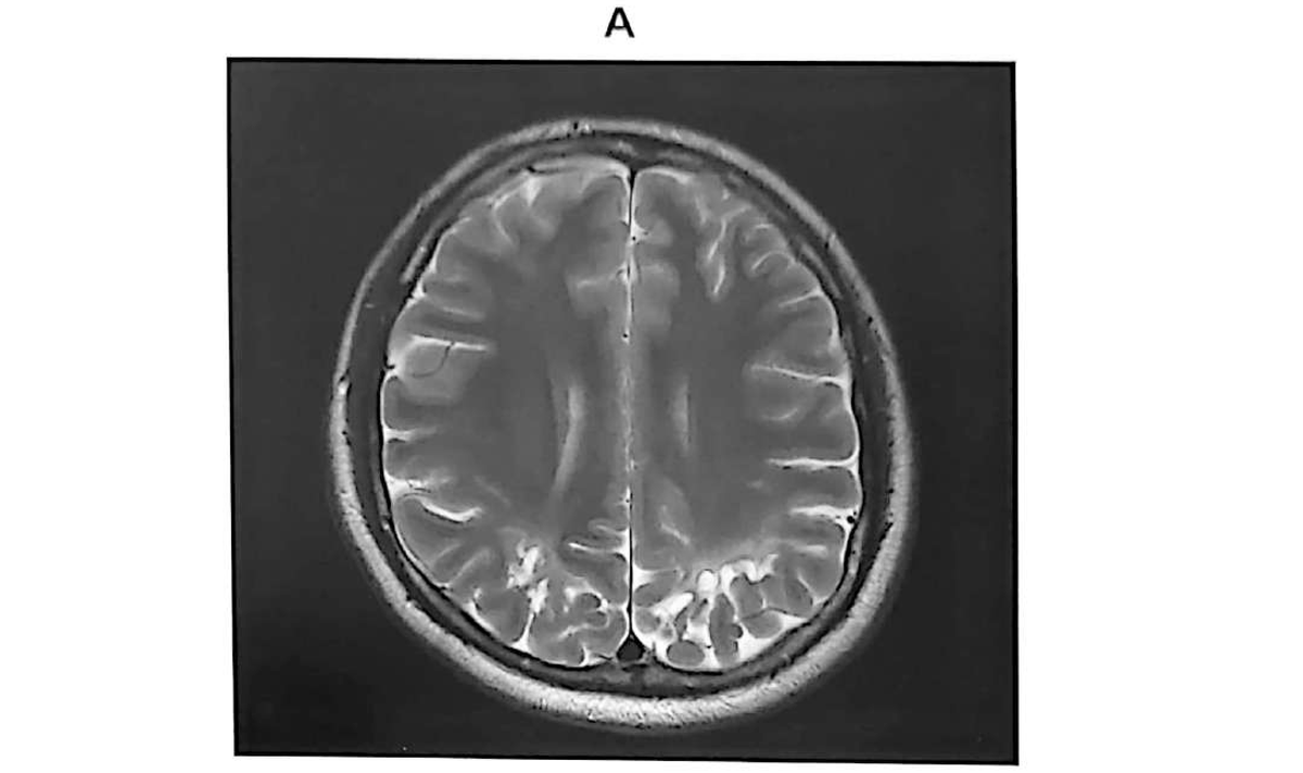 Figure 11.16 A · MRI T2 axial sequence showing bilateral parieto-occipital gliosis and ulegyria.