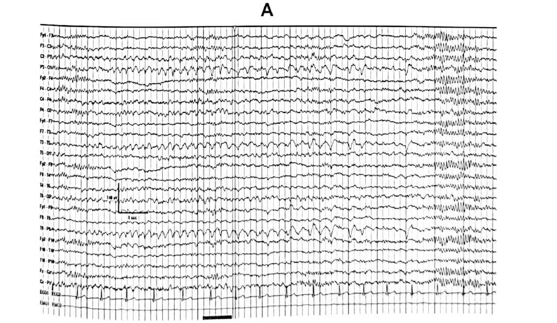 Figure 11.16 C · Activation of bilateral independent sharp waves over the posterior head regions, phase reversing at T5 and T6.