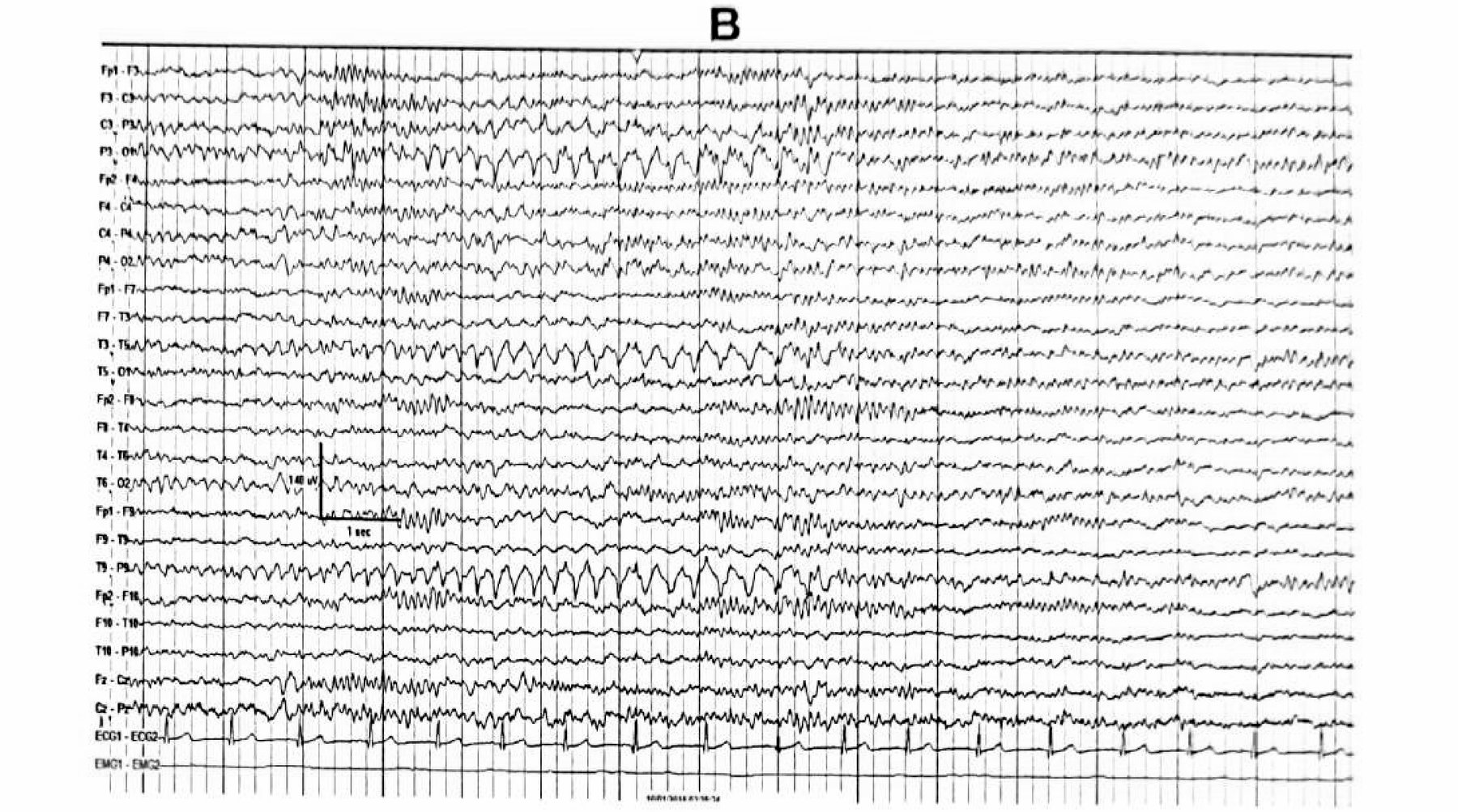 Figure 11.17 A · Intermittent rhythmic delta activity over the left posterior temporo-occipital region, simulating occipital intermittent rhythmic delta activity (OIRDA).