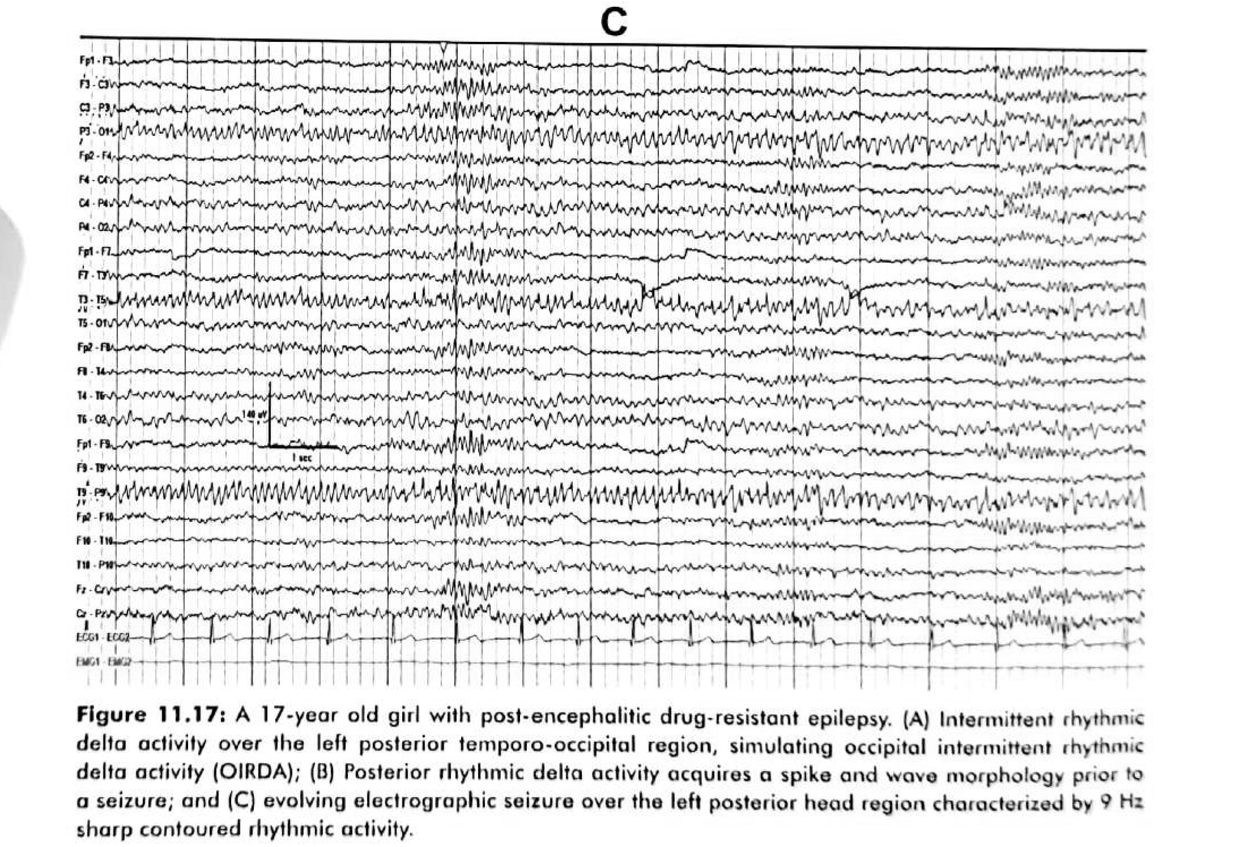 Figure 11.17 B · Posterior rhythmic delta activity acquires a spike-and-wave morphology prior to a seizure, then evolves into an electrographic seizure over the left posterior head region at 9 Hz.