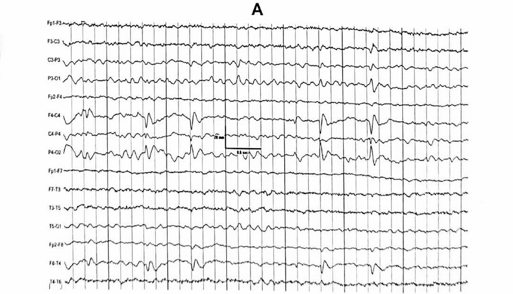Figure 11.1 A · Sharp wave — pointed peak, duration 70–200 ms, clearly distinguishable from background. Bipolar montage, 18 channels.
