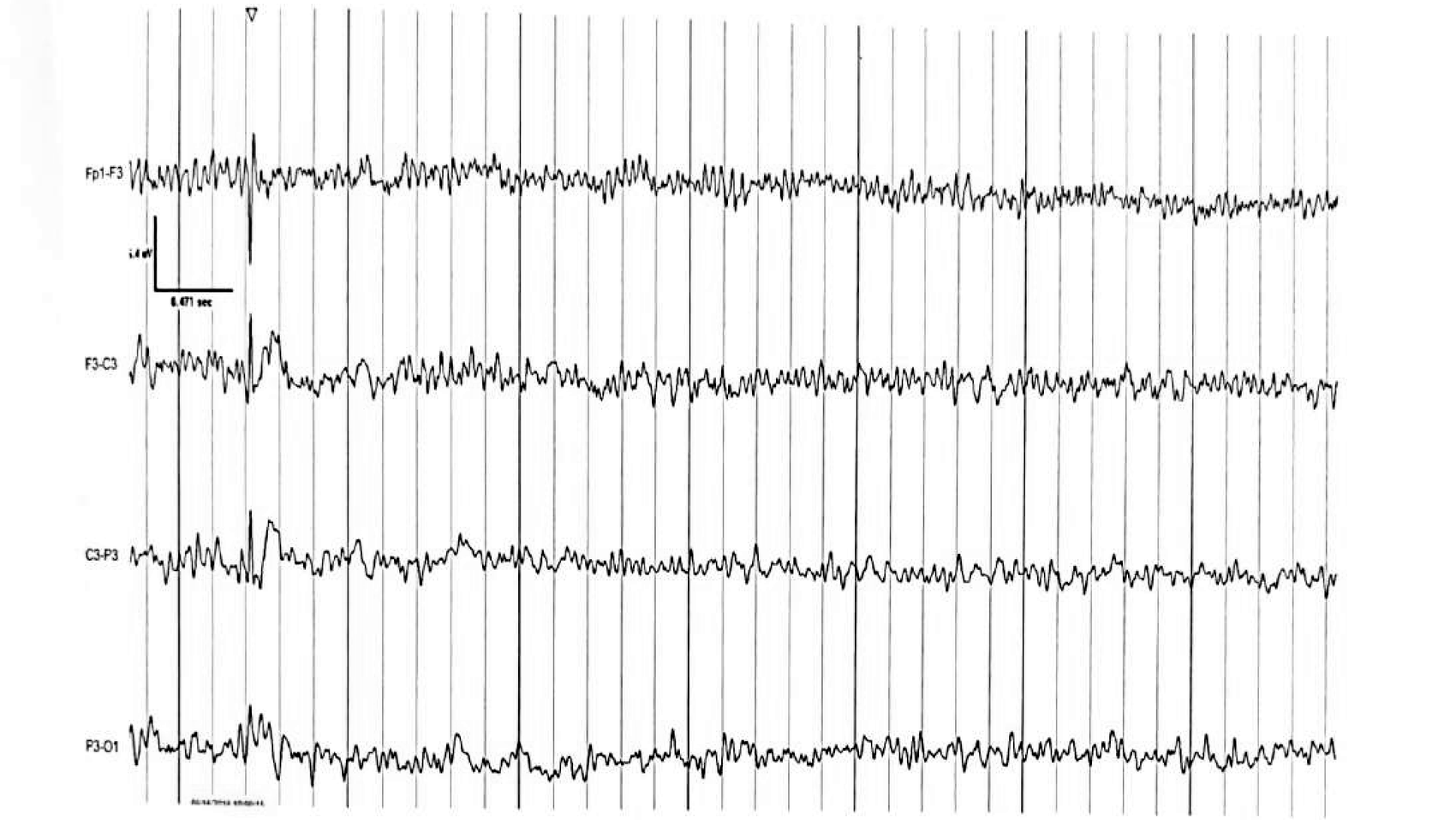 Figure 11.1 B · Spike — similar configuration to a sharp wave but duration 20–70 ms.