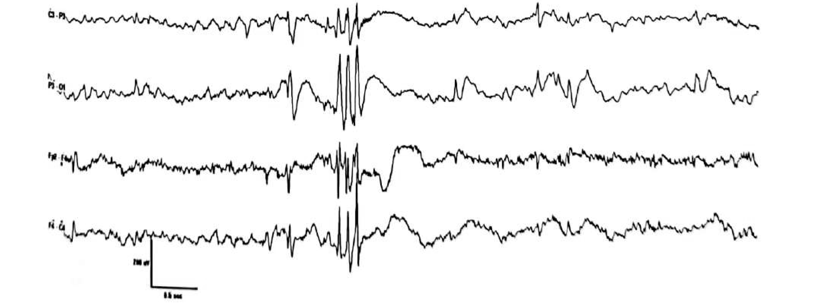 Figure 11.1 C · Multiple spikes — two or more spikes in succession at >10 Hz, each complex optionally followed by a slow wave.