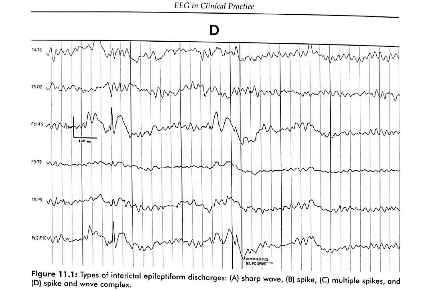 Figure 11.1 D · Spike-and-wave complex — a spike immediately followed by a dome-shaped slow wave of >200 ms.