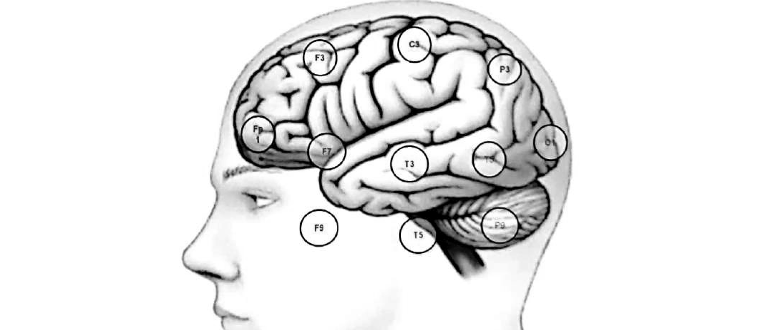 Figure 11.3 · Locations of the basal temporal electrodes. Each basal electrode is located in the coronal plane defined by its superior counterpart.
