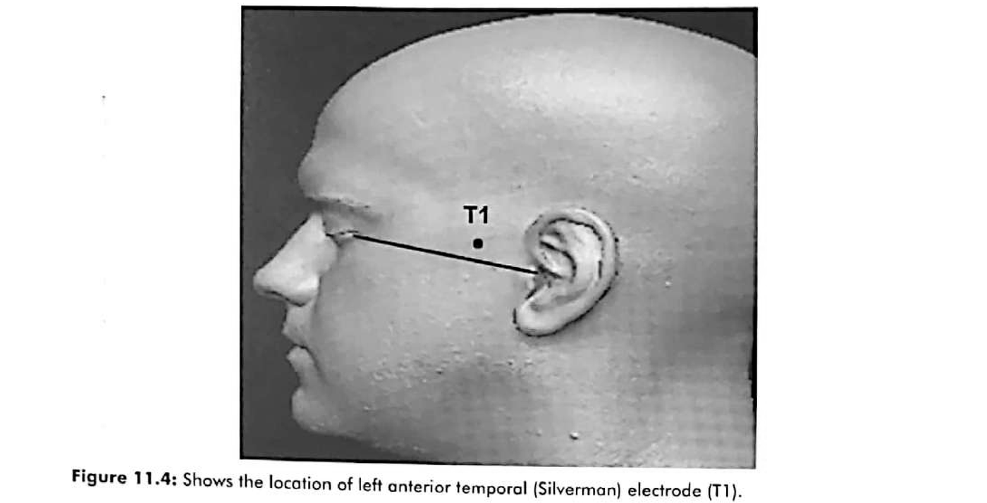 Figure 11.4 · Location of the left anterior temporal (Silverman) electrode, T1.