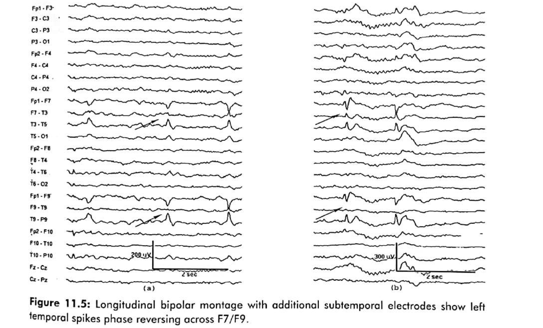Figure 11.5 · Longitudinal bipolar montage with additional subtemporal electrodes, showing left temporal spikes phase reversing across F7/F9.