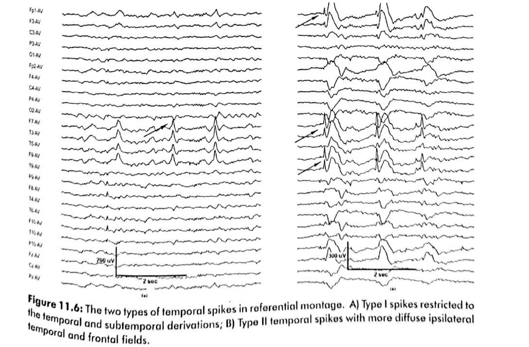 Figure 11.6 · Referential montage. A — Type 1 spikes restricted to the temporal and subtemporal derivations; B — Type II spikes with more diffuse ipsilateral temporal and frontal fields.