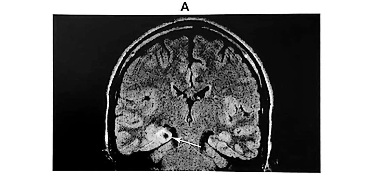Figure 11.7 A · MRI showing a low-grade neoplasm over the right anterio-mesial temporal lobe, in a 30-year-old woman with drug-resistant automotor seizures of right temporal semiology.