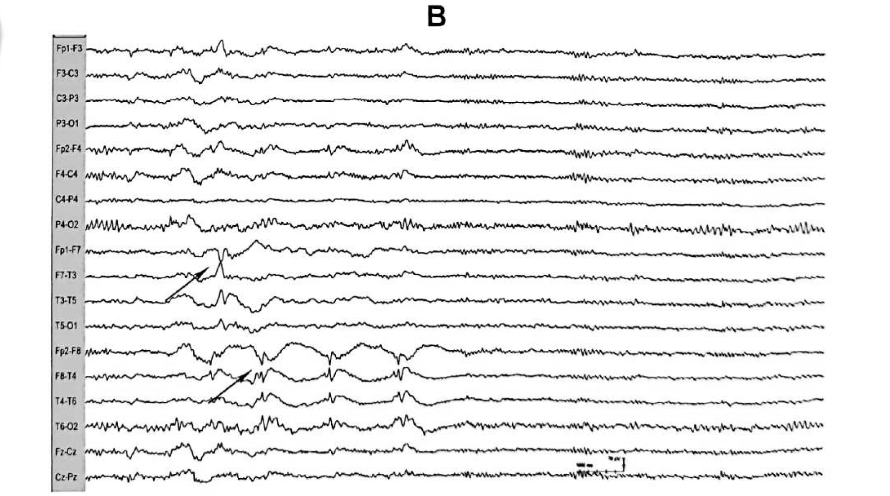Figure 11.7 B · Bilateral independent anterior temporal IEDs, <strong>90% of them distributed over the right temporal region</strong>.