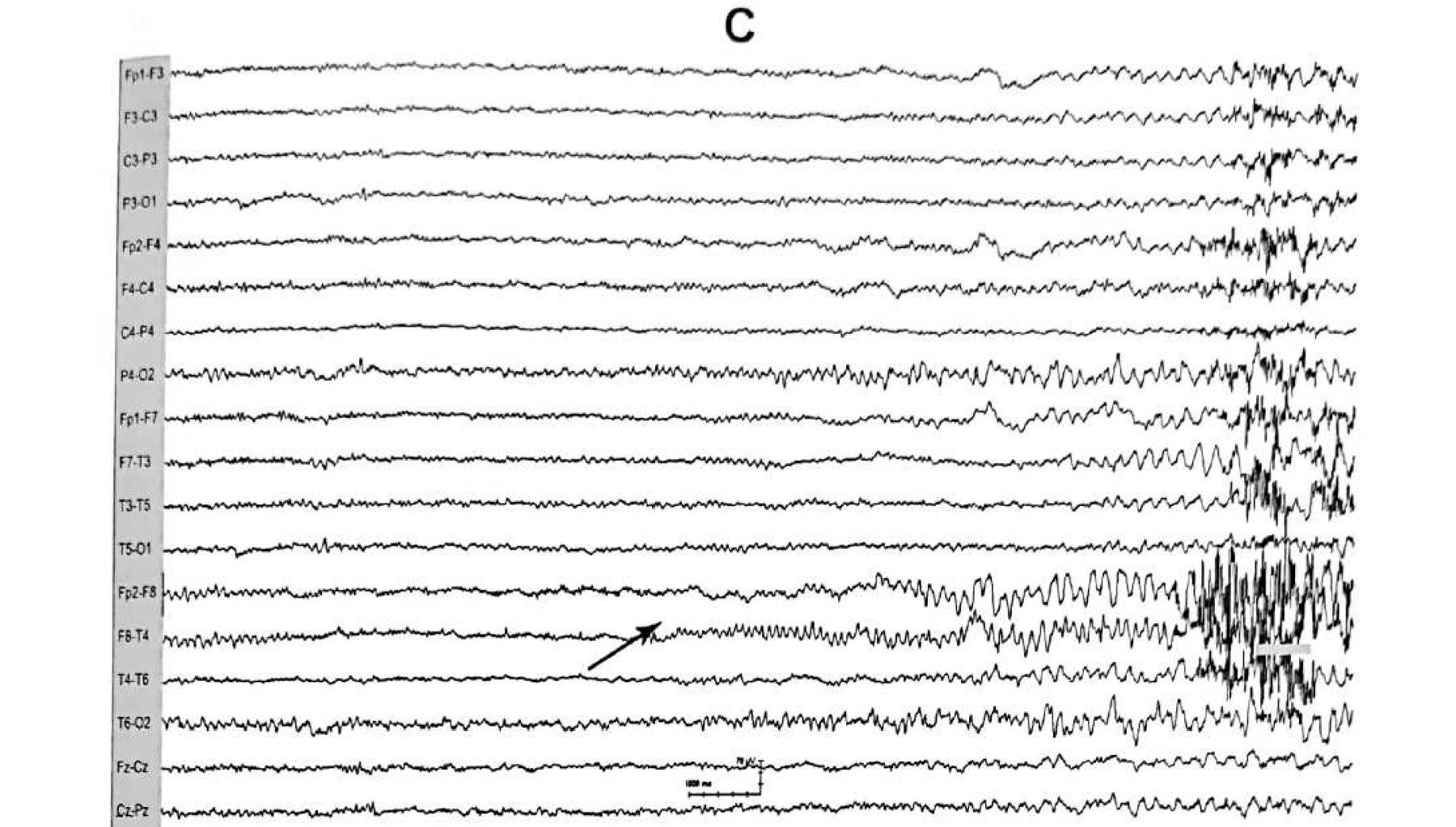 Figure 11.7 C · EEG during one of the recorded seizures, showing evolving rhythmic beta to theta rhythm over the right anterior temporal region.