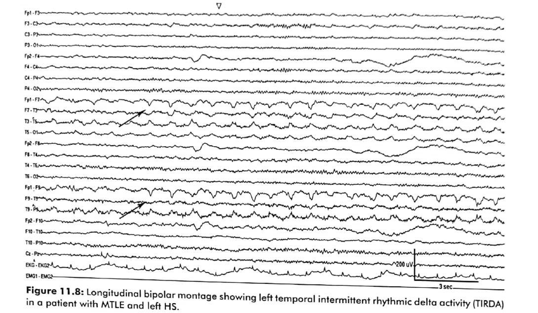 Figure 11.8 · Longitudinal bipolar montage showing left temporal intermittent rhythmic delta activity in a patient with mesial temporal lobe epilepsy and left hippocampal sclerosis.