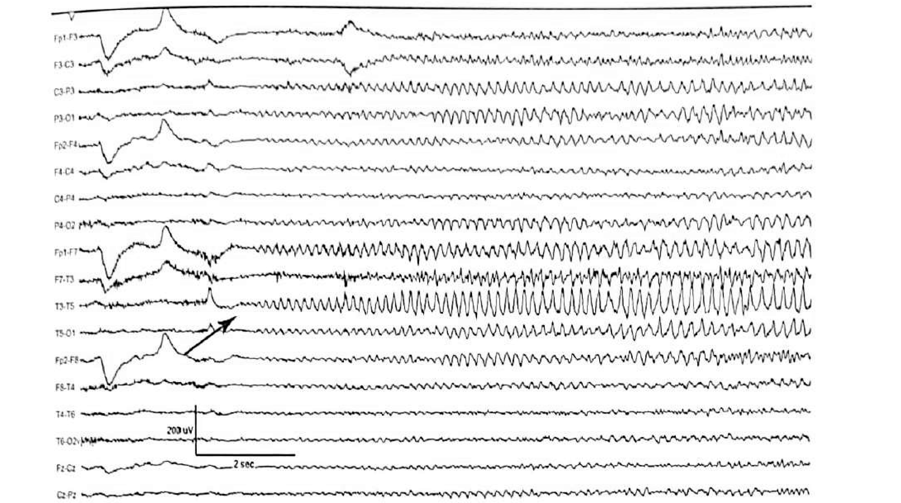 Figure 11.9 A · Type I A pattern showing rhythmic 5 Hz sharp-contoured theta rhythm over the left temporal region.