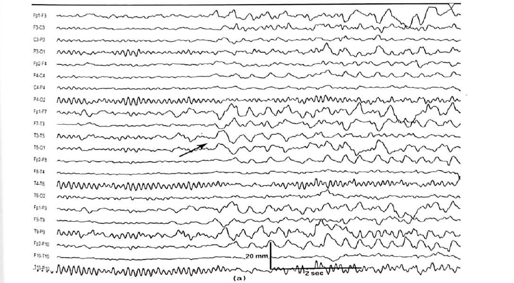 Figure 11.9 B · Type II A pattern showing polymorphic delta activity over the left temporal region.