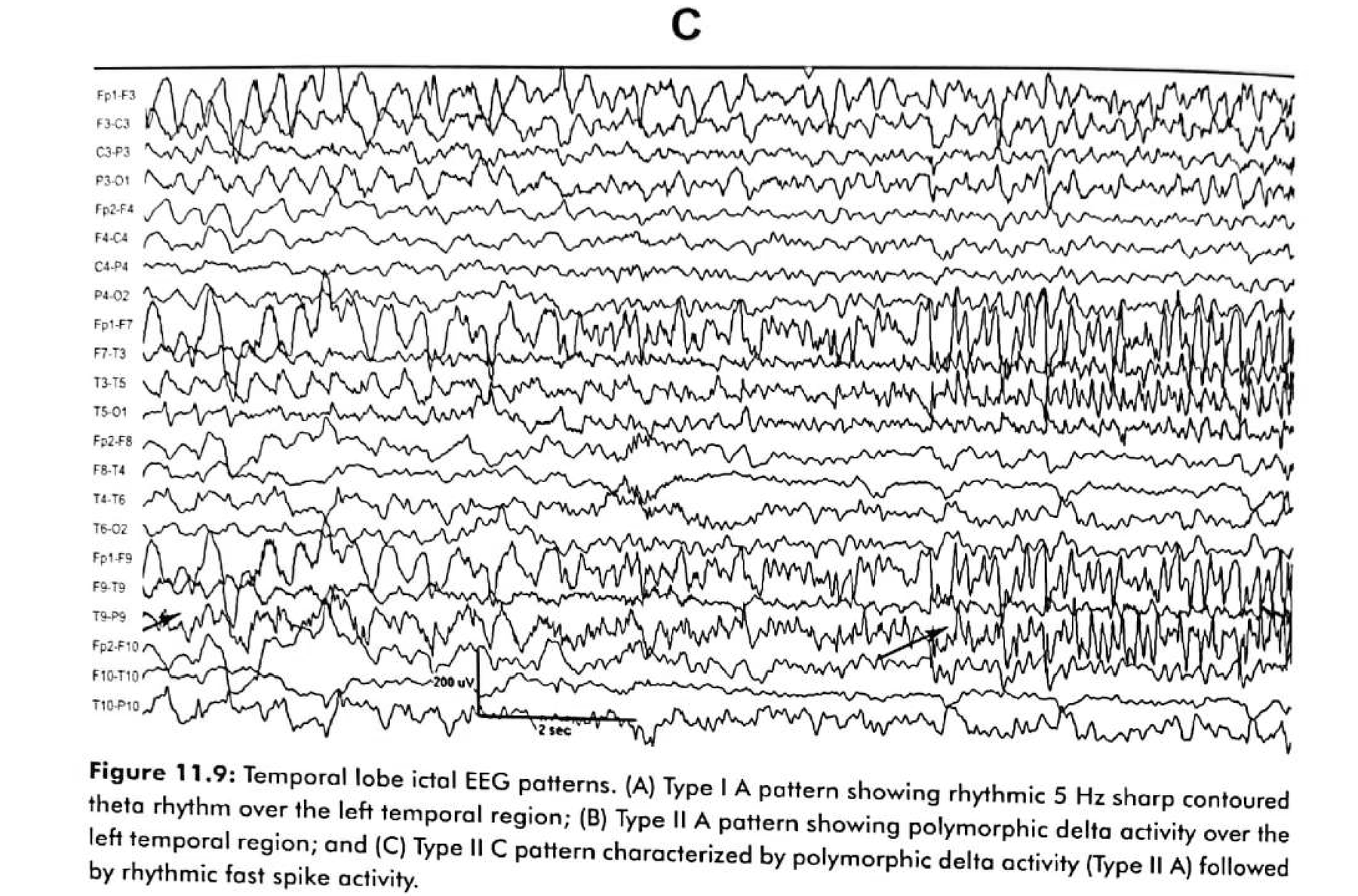 Figure 11.9 C · Type II C pattern characterised by polymorphic delta activity (Type II A) followed by rhythmic fast spike activity.